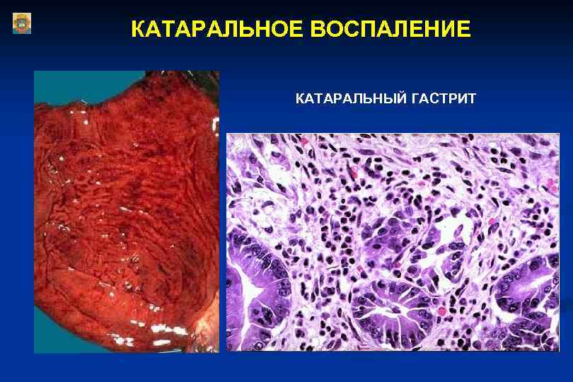 КАТАРАЛЬНОЕ ВОСПАЛЕНИЕ КАТАРАЛЬНЫЙ ГАСТРИТ 