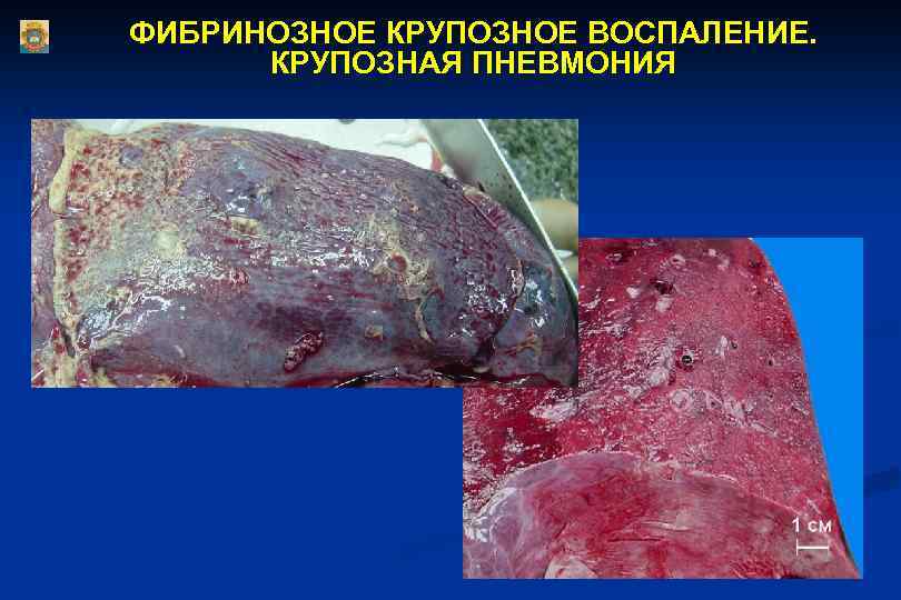 ФИБРИНОЗНОЕ КРУПОЗНОЕ ВОСПАЛЕНИЕ. КРУПОЗНАЯ ПНЕВМОНИЯ 