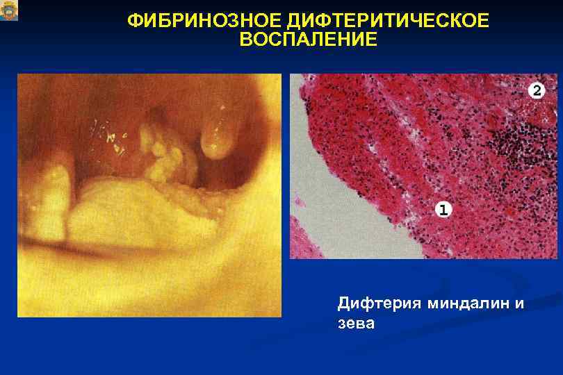 ФИБРИНОЗНОЕ ДИФТЕРИТИЧЕСКОЕ ВОСПАЛЕНИЕ Дифтерия миндалин и зева 