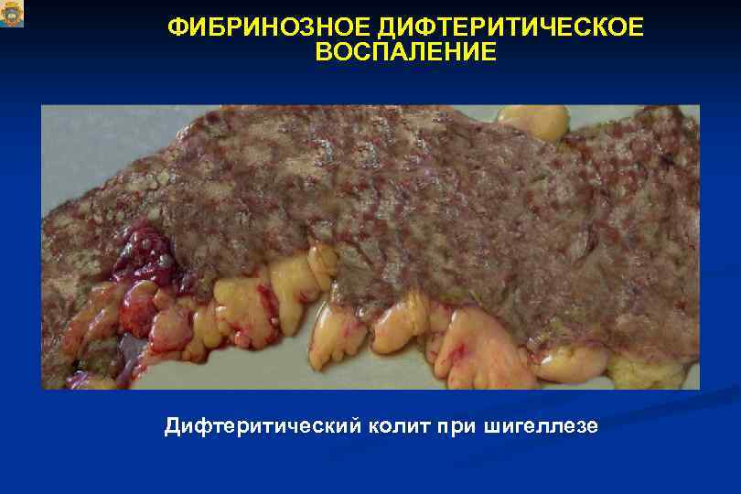 ФИБРИНОЗНОЕ ДИФТЕРИТИЧЕСКОЕ ВОСПАЛЕНИЕ Дифтеритический колит при шигеллезе 