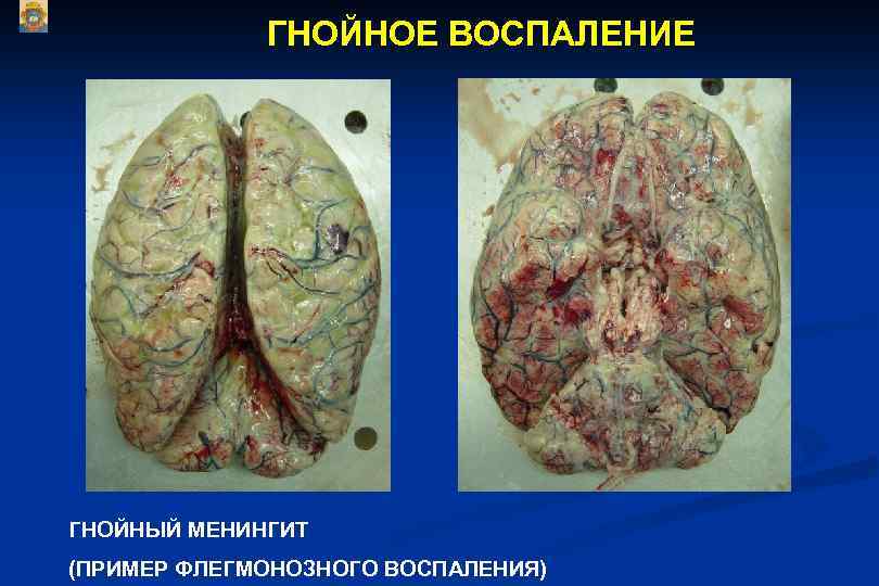 ГНОЙНОЕ ВОСПАЛЕНИЕ ГНОЙНЫЙ МЕНИНГИТ (ПРИМЕР ФЛЕГМОНОЗНОГО ВОСПАЛЕНИЯ) 