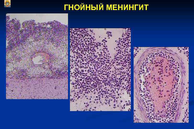 ГНОЙНЫЙ МЕНИНГИТ 
