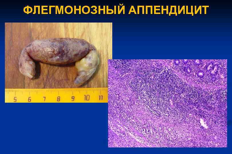 ФЛЕГМОНОЗНЫЙ АППЕНДИЦИТ 