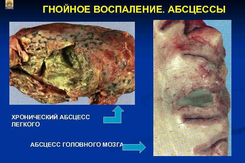 ГНОЙНОЕ ВОСПАЛЕНИЕ. АБСЦЕССЫ ХРОНИЧЕСКИЙ АБСЦЕСС ЛЕГКОГО АБСЦЕСС ГОЛОВНОГО МОЗГА 