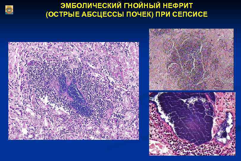 Эмболический гнойный нефрит микропрепарат рисунок