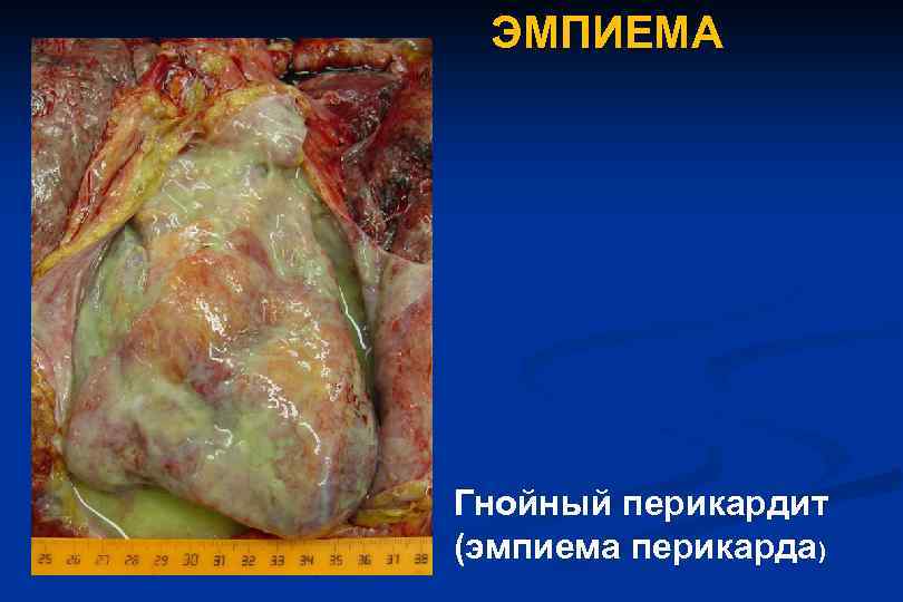 ЭМПИЕМА Гнойный перикардит (эмпиема перикарда) 