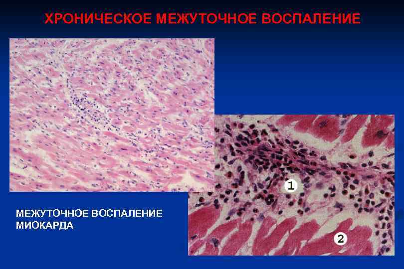 ХРОНИЧЕСКОЕ МЕЖУТОЧНОЕ ВОСПАЛЕНИЕ МИОКАРДА 