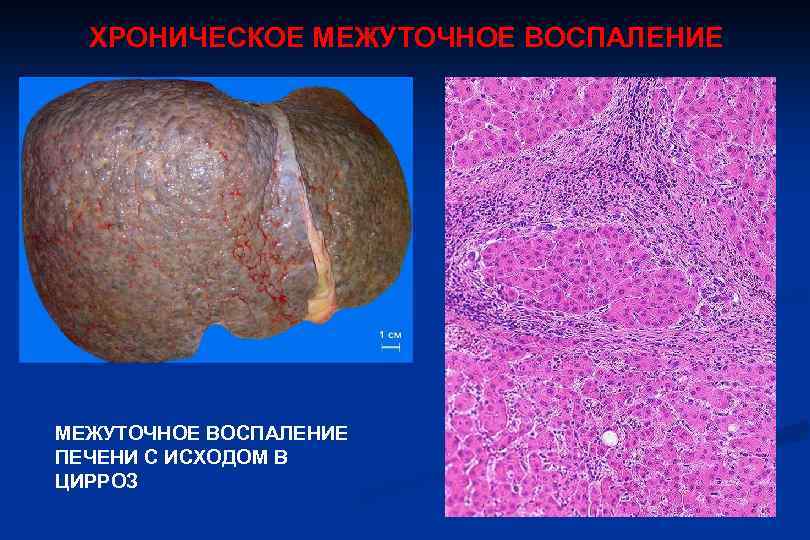 ХРОНИЧЕСКОЕ МЕЖУТОЧНОЕ ВОСПАЛЕНИЕ ПЕЧЕНИ С ИСХОДОМ В ЦИРРОЗ 