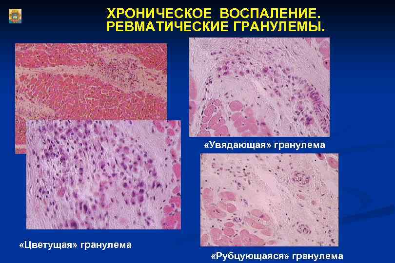 ХРОНИЧЕСКОЕ ВОСПАЛЕНИЕ. РЕВМАТИЧЕСКИЕ ГРАНУЛЕМЫ. «Увядающая» гранулема «Цветущая» гранулема «Рубцующаяся» гранулема 