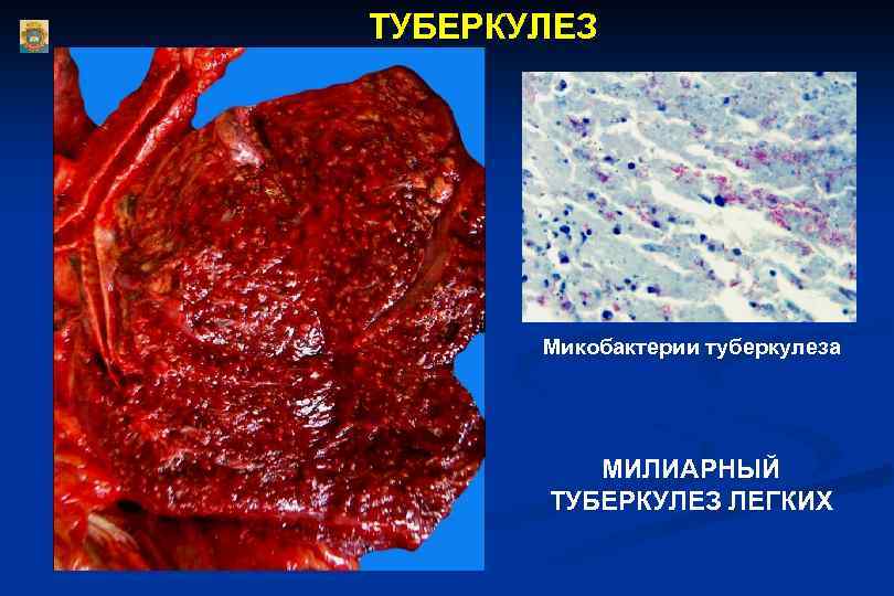 ТУБЕРКУЛЕЗ Микобактерии туберкулеза МИЛИАРНЫЙ ТУБЕРКУЛЕЗ ЛЕГКИХ 