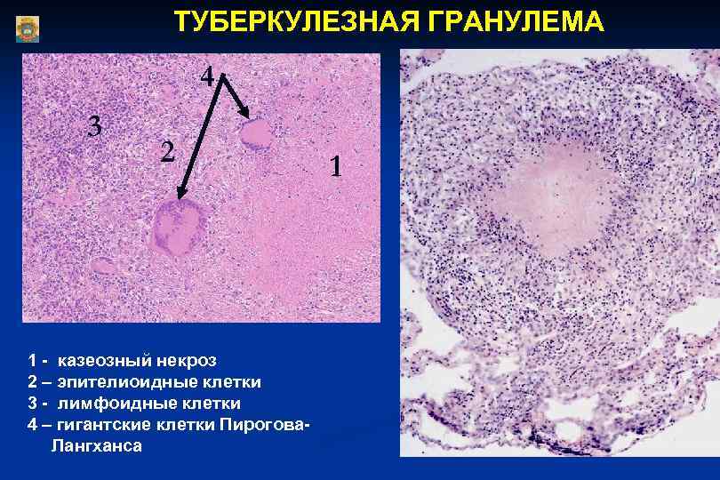 ТУБЕРКУЛЕЗНАЯ ГРАНУЛЕМА 4 3 2 1 - казеозный некроз 2 – эпителиоидные клетки 3