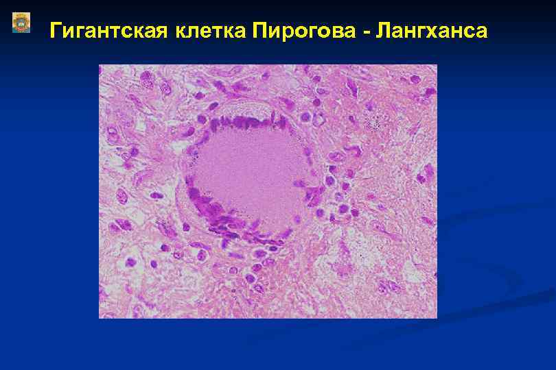 Гигантская клетка Пирогова - Лангханса 