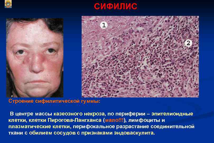 СИФИЛИС Строение сифилитической гуммы: В центре массы казеозного некроза, по периферии – эпителиоидные клетки,