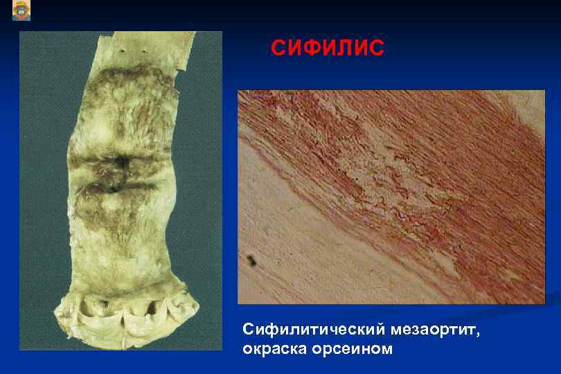 СИФИЛИС Сифилитический мезаортит, окраска орсеином 