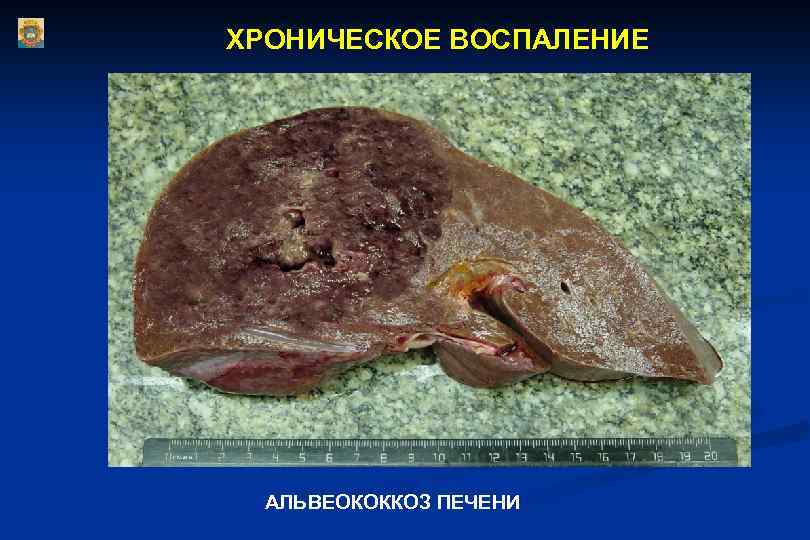 ХРОНИЧЕСКОЕ ВОСПАЛЕНИЕ АЛЬВЕОКОККОЗ ПЕЧЕНИ 