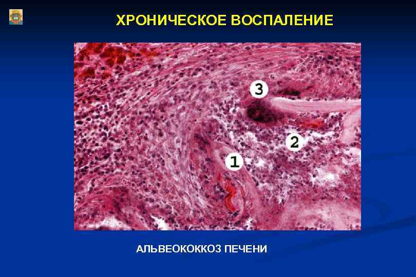 ХРОНИЧЕСКОЕ ВОСПАЛЕНИЕ АЛЬВЕОКОККОЗ ПЕЧЕНИ 