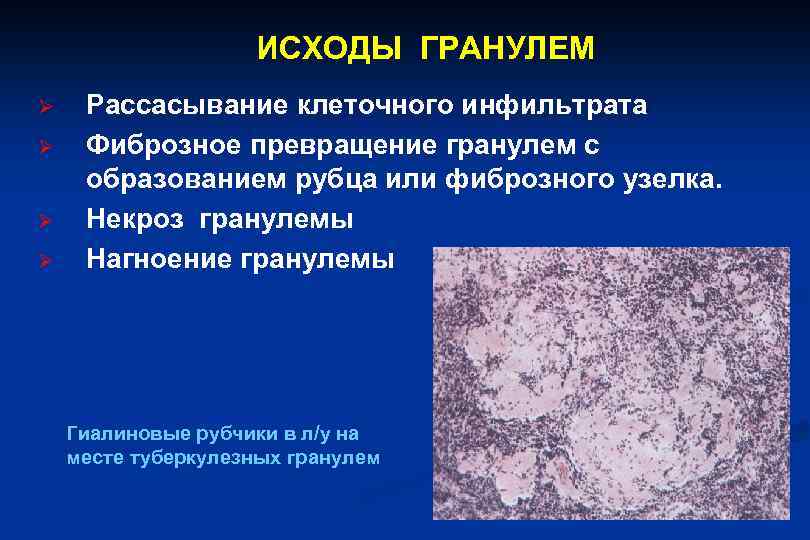 ИСХОДЫ ГРАНУЛЕМ Ø Ø Рассасывание клеточного инфильтрата Фиброзное превращение гранулем с образованием рубца или