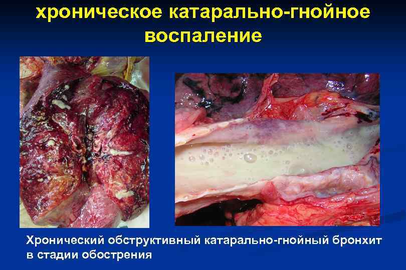 хроническое катарально-гнойное воспаление Хронический обструктивный катарально-гнойный бронхит в стадии обострения 