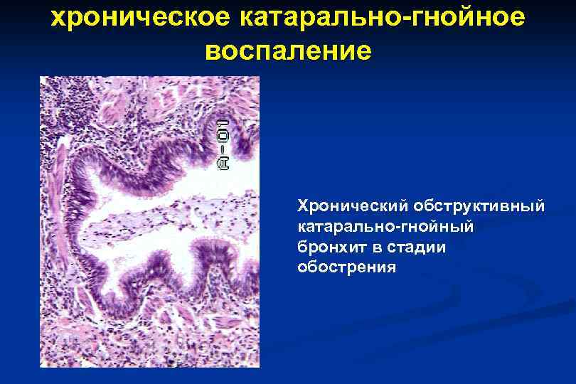 хроническое катарально-гнойное воспаление Хронический обструктивный катарально-гнойный бронхит в стадии обострения 