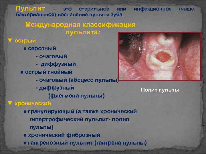 Пульпит – это стерильное или бактериальное) воспаление пульпы зуба. инфекционное Международная классификация пульпита: ▼