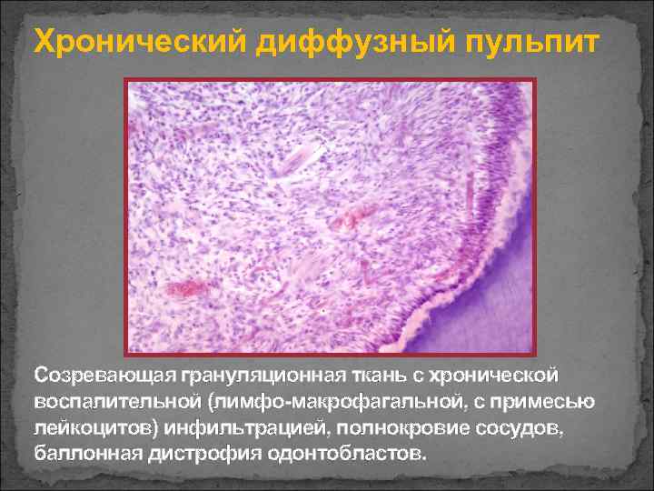 Хронический диффузный пульпит Созревающая грануляционная ткань с хронической воспалительной (лимфо-макрофагальной, с примесью лейкоцитов) инфильтрацией,