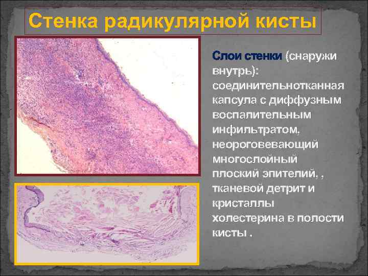 Стенка радикулярной кисты Слои стенки (снаружи внутрь): соединительнотканная капсула с диффузным воспалительным инфильтратом, неороговевающий