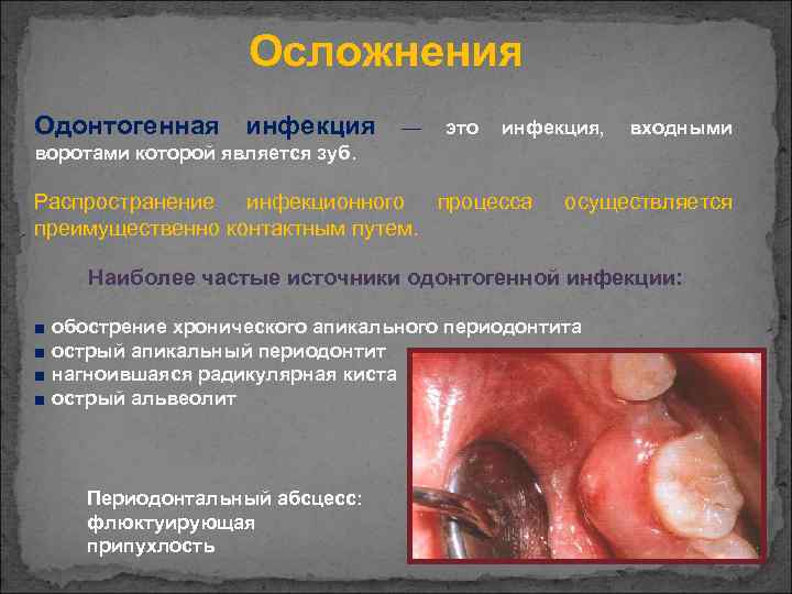 Осложнения Одонтогенная инфекция — это инфекция, входными воротами которой является зуб. Распространение инфекционного процесса