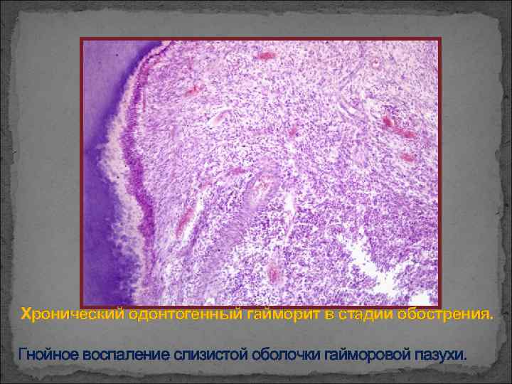 Хронический одонтогенный гайморит в стадии обострения. Гнойное воспаление слизистой оболочки гайморовой пазухи. 