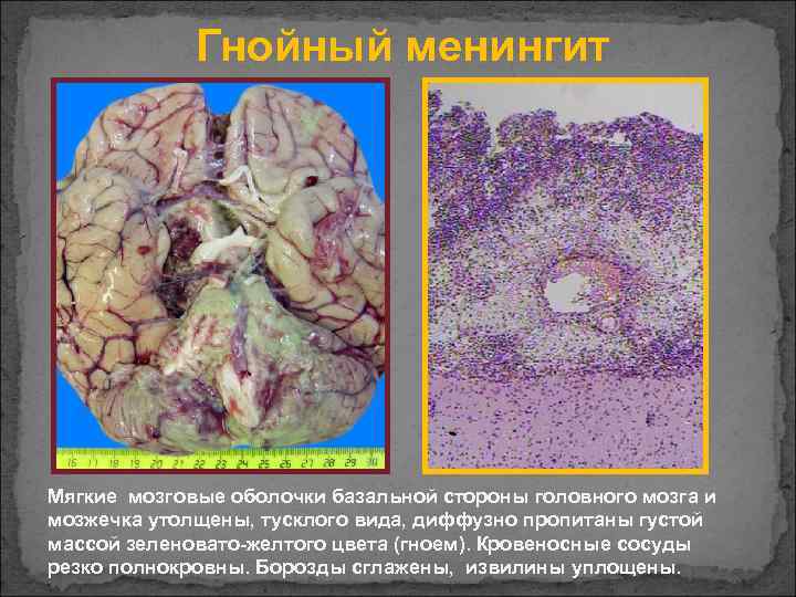 Гнойный менингит Мягкие мозговые оболочки базальной стороны головного мозга и мозжечка утолщены, тусклого вида,