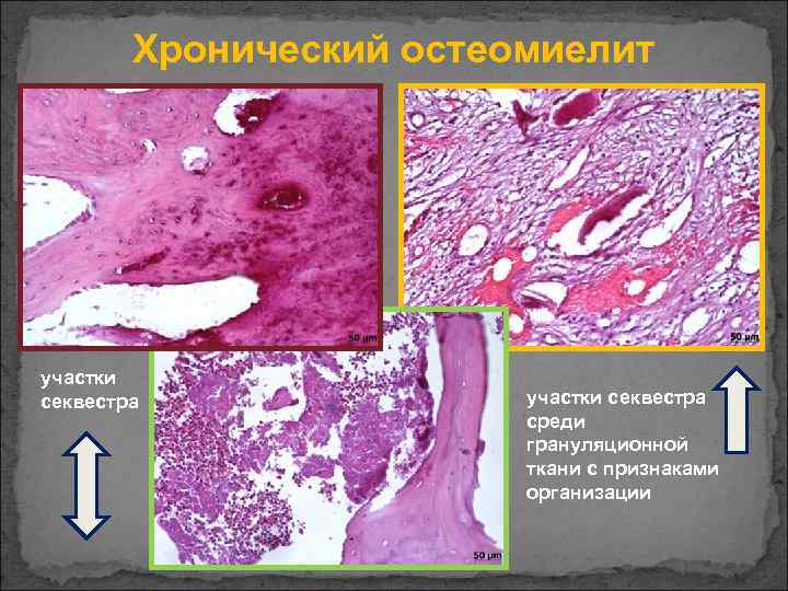 Хронический остеомиелит участки секвестра среди грануляционной ткани с признаками организации 