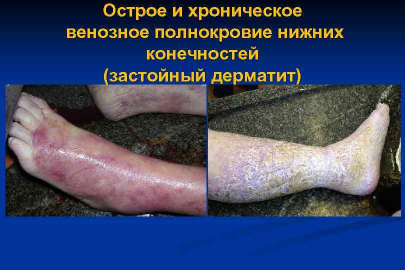Острое и хроническое венозное полнокровие нижних конечностей (застойный дерматит) 