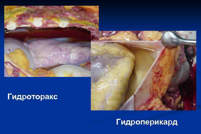 Гидроторакс Гидроперикард 