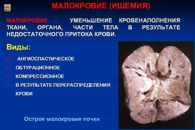 МАЛОКРОВИЕ (ИШЕМИЯ) МАЛОКРОВИЕ УМЕНЬШЕНИЕ КРОВЕНАПОЛНЕНИЯ ТКАНИ, ОРГАНА, ЧАСТИ ТЕЛА В РЕЗУЛЬТАТЕ НЕДОСТАТОЧНОГО ПРИТОКА КРОВИ.