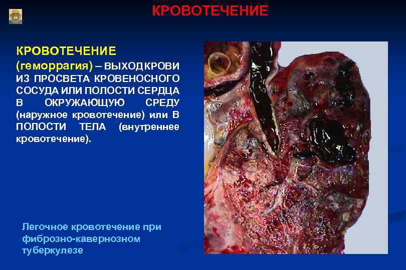 КРОВОТЕЧЕНИЕ (геморрагия) – ВЫХОД КРОВИ ИЗ ПРОСВЕТА КРОВЕНОСНОГО СОСУДА ИЛИ ПОЛОСТИ СЕРДЦА В ОКРУЖАЮЩУЮ