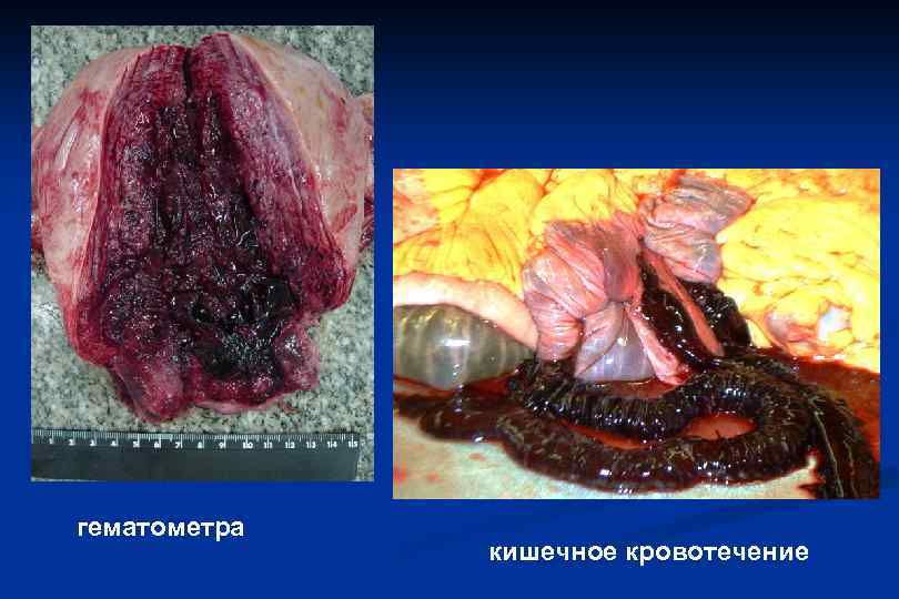 гематометра кишечное кровотечение 