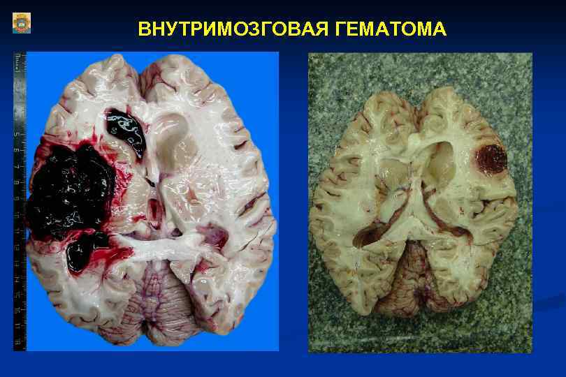 ВНУТРИМОЗГОВАЯ ГЕМАТОМА 