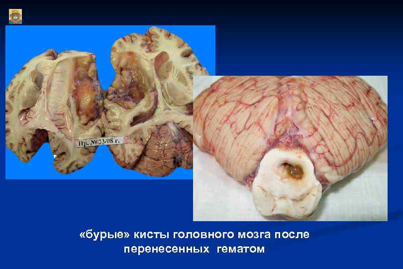  «бурые» кисты головного мозга после перенесенных гематом 