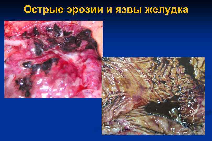 Острые эрозии и язвы желудка 