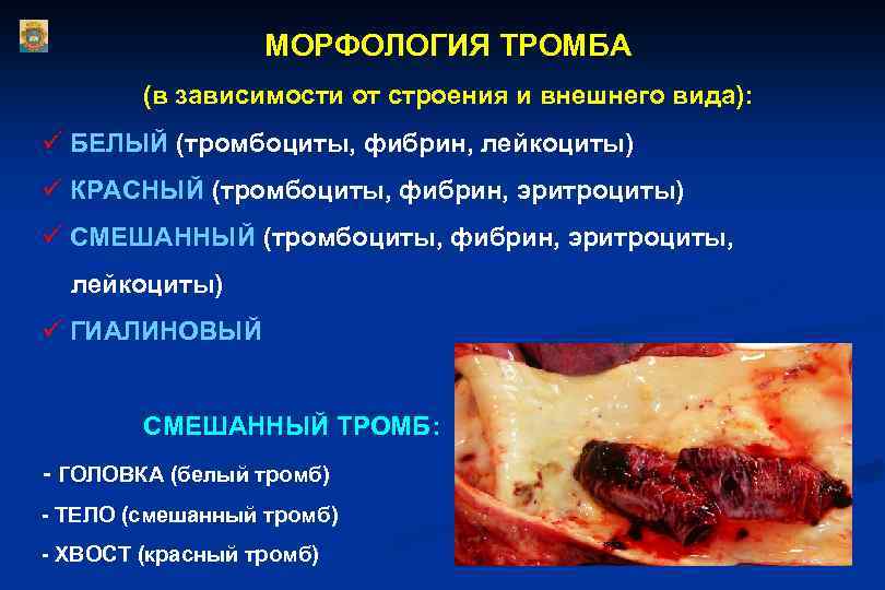МОРФОЛОГИЯ ТРОМБА (в зависимости от строения и внешнего вида): ü БЕЛЫЙ (тромбоциты, фибрин, лейкоциты)