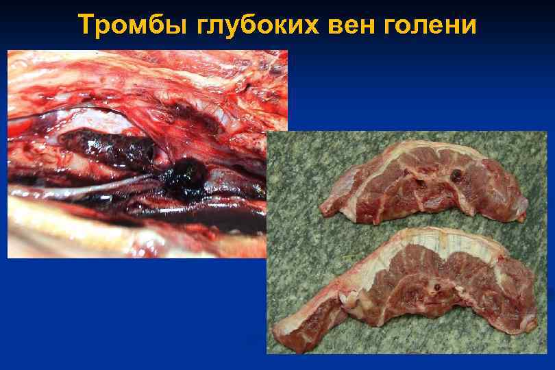 Тромбы глубоких вен голени 