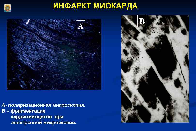 ИНФАРКТ МИОКАРДА А А- поляризационная микроскопия. В – фрагментация кардиомиоцитов при электронной микроскопии. В
