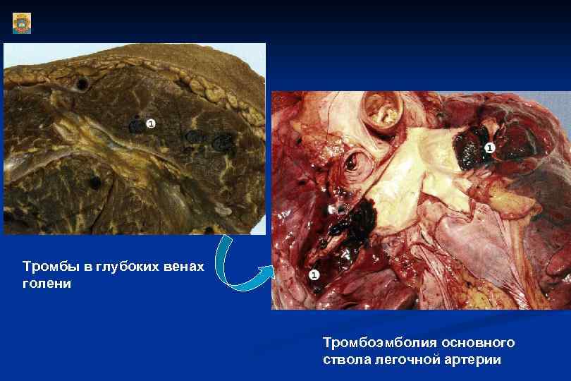 Тромбы в глубоких венах голени Тромбоэмболия основного ствола легочной артерии 