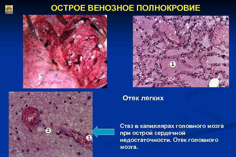ОСТРОЕ ВЕНОЗНОЕ ПОЛНОКРОВИЕ Отек легких Стаз в капиллярах головного мозга при острой сердечной недостаточности.