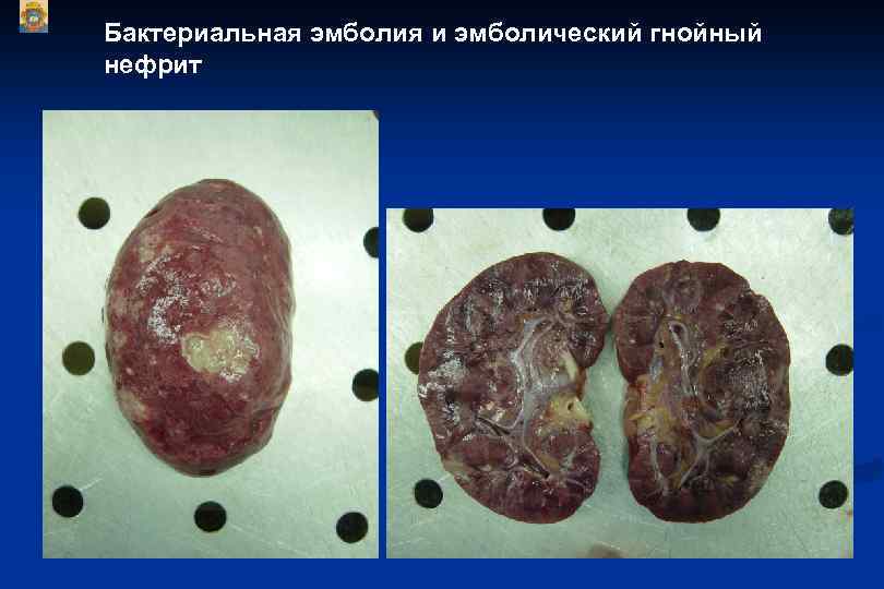 Бактериальная эмболия и эмболический гнойный нефрит 