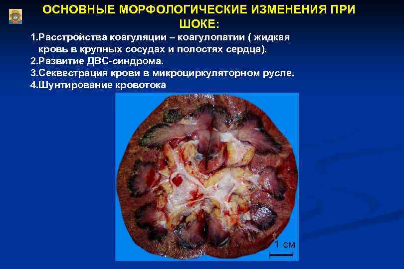 ОСНОВНЫЕ МОРФОЛОГИЧЕСКИЕ ИЗМЕНЕНИЯ ПРИ ШОКЕ: 1. Расстройства коагуляции – коагулопатии ( жидкая кровь в