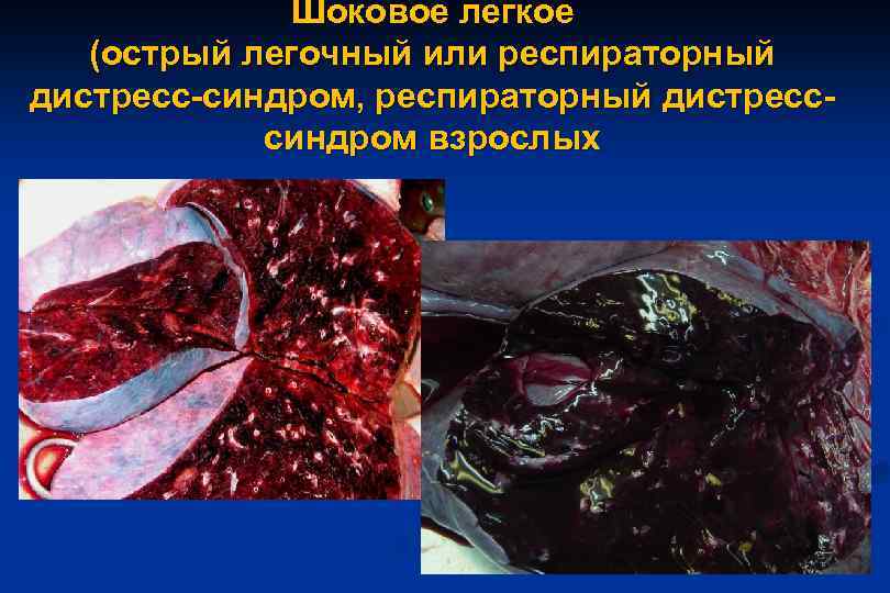 Шоковое легкое (острый легочный или респираторный дистресс-синдром, респираторный дистресссиндром взрослых 