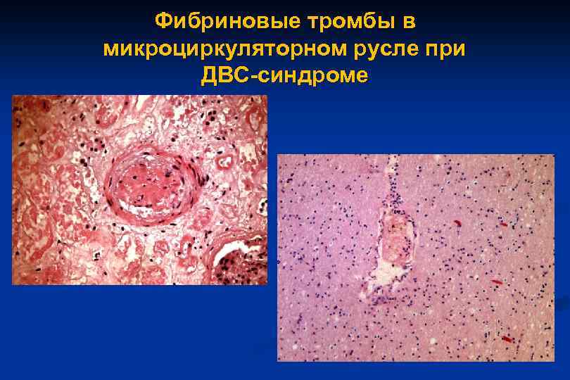 Фибриновые тромбы в микроциркуляторном русле при ДВС-синдроме 