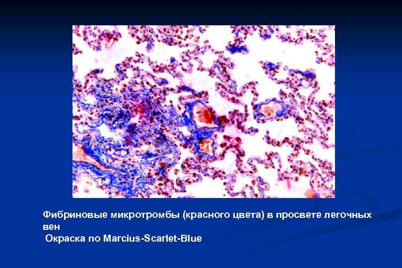 Фибриновые микротромбы (красного цвета) в просвете легочных вен Окраска по Marcius-Scarlet-Blue 