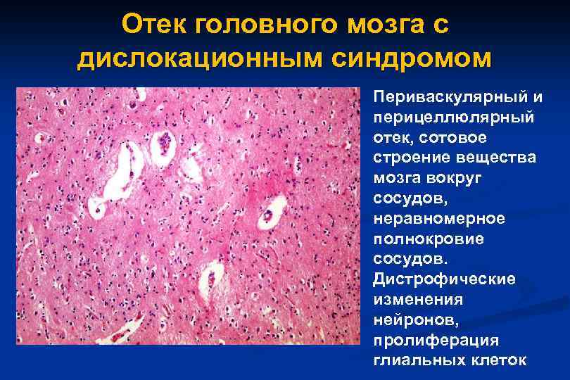 Глиобластома микропрепарат рисунок