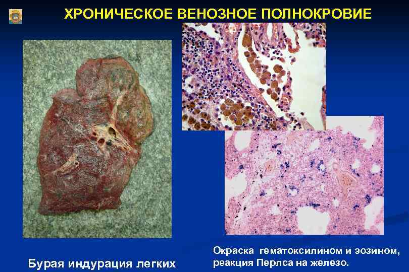ХРОНИЧЕСКОЕ ВЕНОЗНОЕ ПОЛНОКРОВИЕ Бурая индурация легких Окраска гематоксилином и эозином, реакция Перлса на железо.